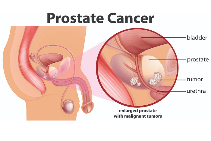 Causes prostate cancer