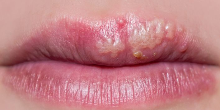 Treats-genital-warts-and-herpes