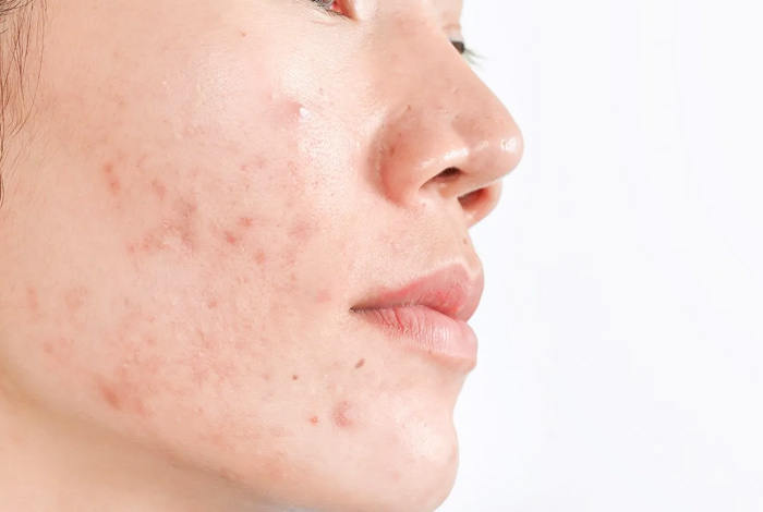 Reduces-hyperpigmentation