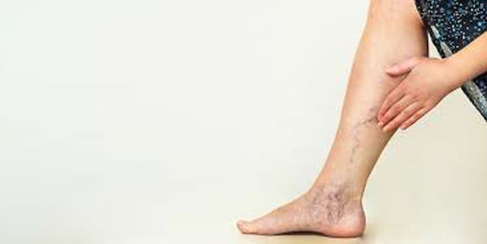 Help-delay-the-onset-of-varicose-veins