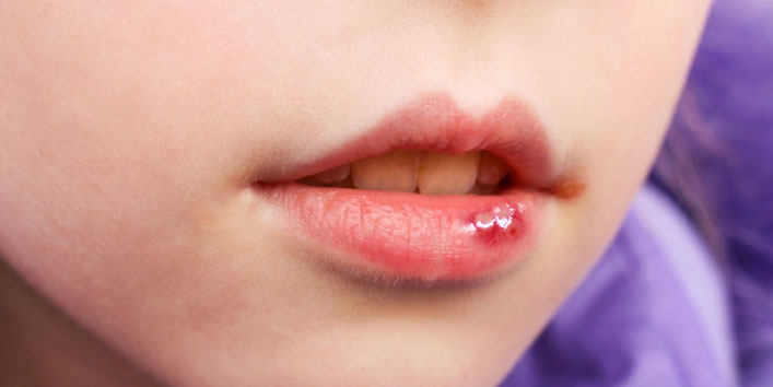 Proven Home Remedies To Treat Mouth Ulcer
