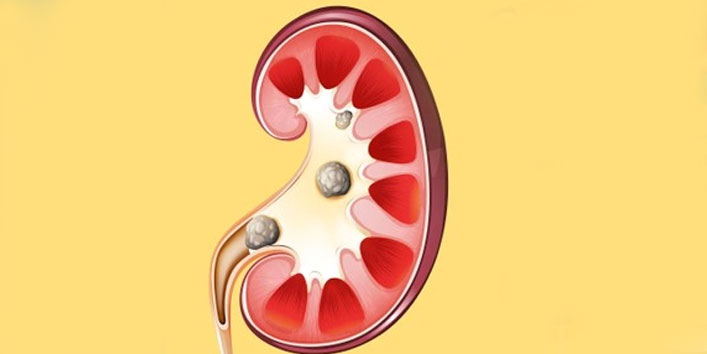 May-cause-kidney-stone