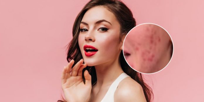 Mask-Pimples-with-Makeup