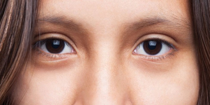 7 Proven Home Remedies to Treat Dry Skin around the Eyes 7 Proven Home Remedies to Treat Dry Skin around the Eyes